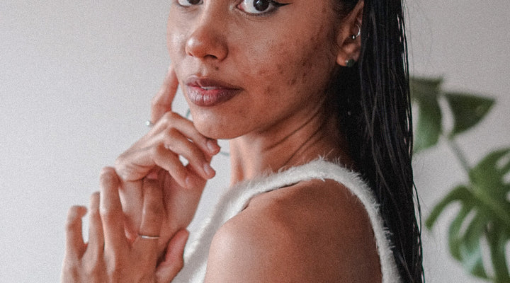 How to love your skin - advice from acne sufferers!