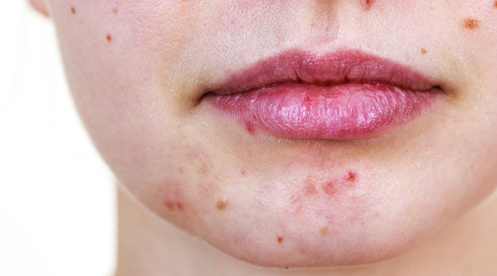 What Do My Chin Spots Mean?